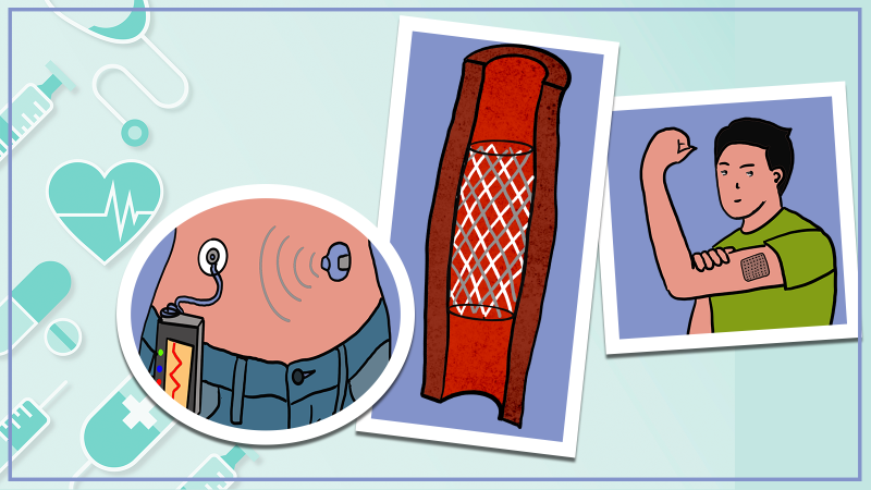 Advanced drug delivery by wearbles and implants: our saviours